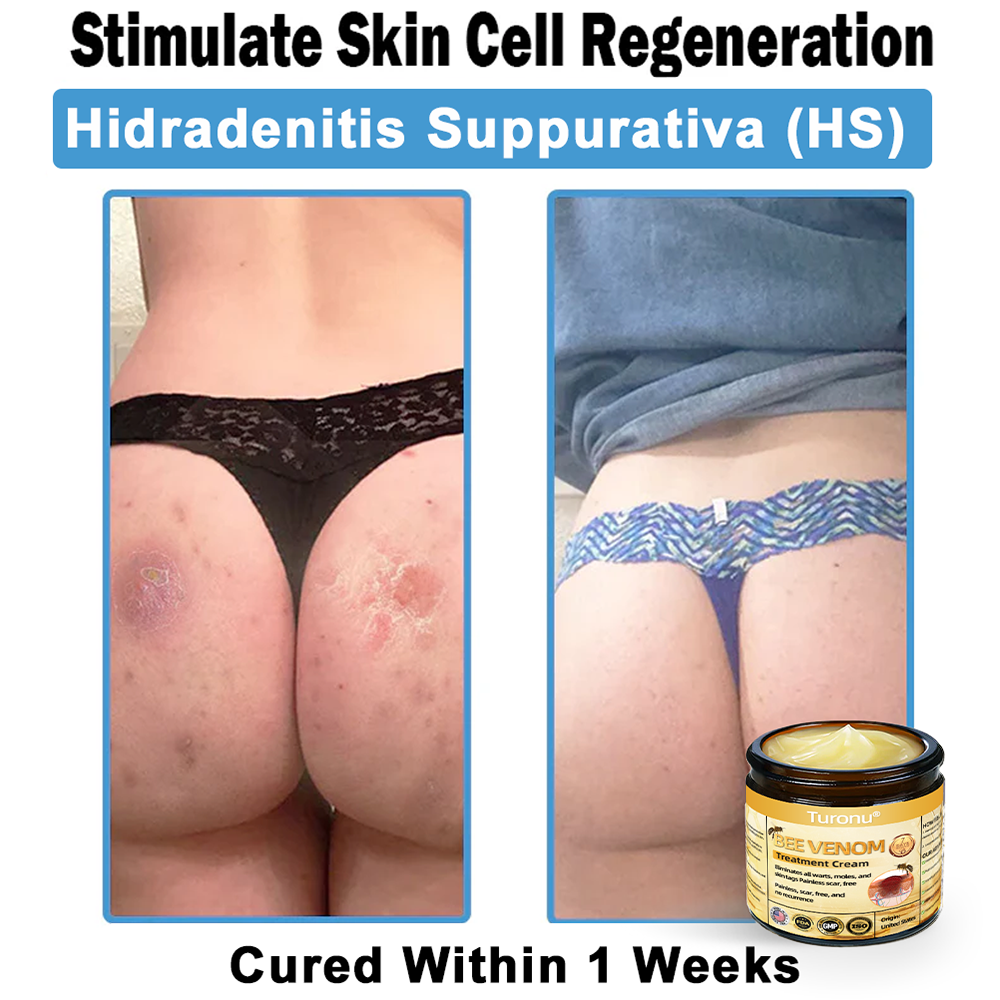 Official Store: Turonu® Bee Venom Skin Treatment Cream👨‍⚕️American Academy of Dermatology (AAD) Approved)💎