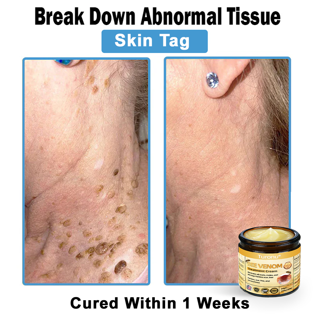 Official Store: Turonu® Bee Venom Skin Treatment Cream👨‍⚕️American Academy of Dermatology (AAD) Approved)💎