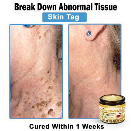 Official Store: Turonu® Bee Venom Skin Treatment Cream👨‍⚕️American Academy of Dermatology (AAD) Approved)💎