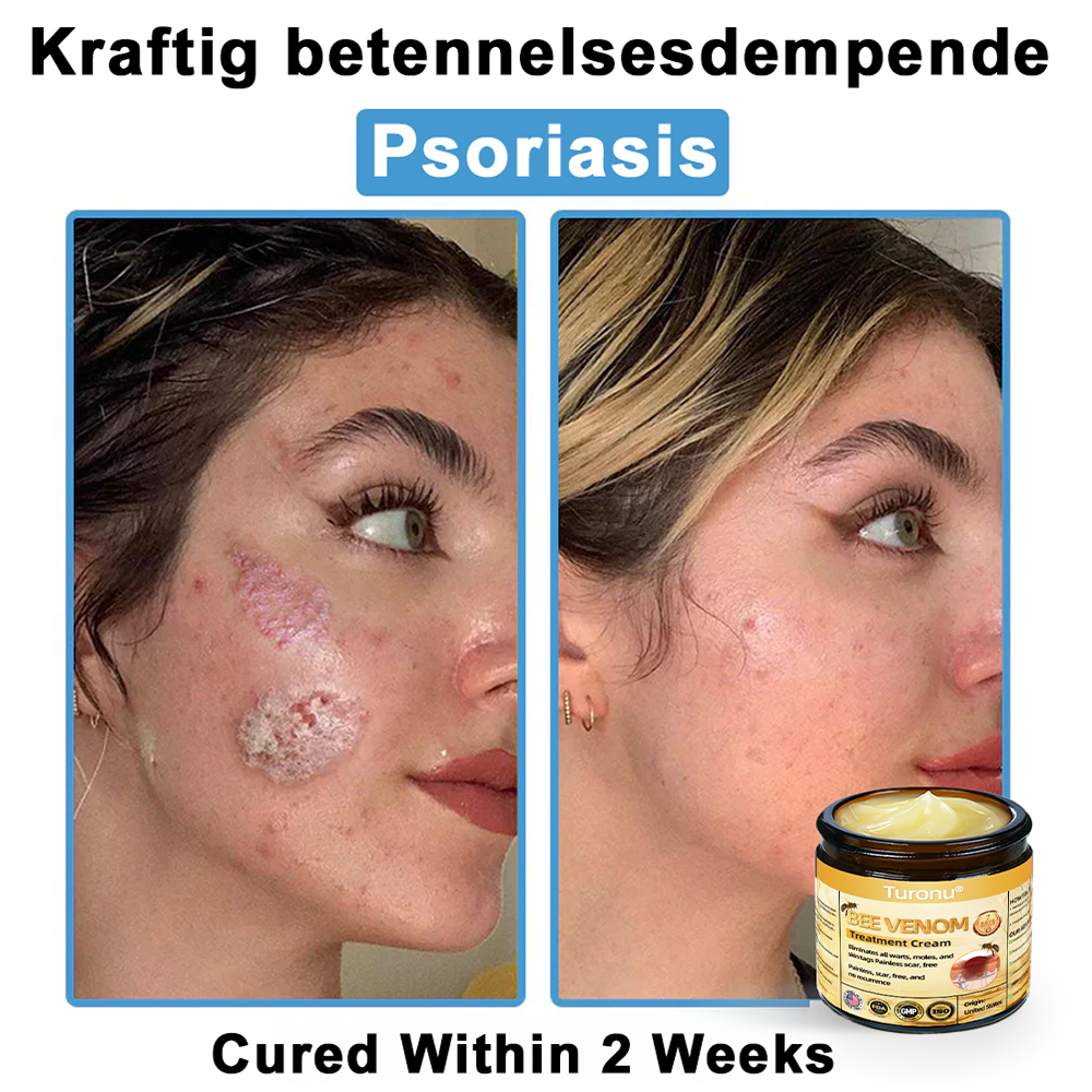 Official Store: Turonu® Bee Venom Skin Treatment Cream👨‍⚕️American Academy of Dermatology (AAD) Approved)💎