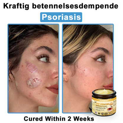 Official Store: Turonu® Bee Venom Skin Treatment Cream👨‍⚕️American Academy of Dermatology (AAD) Approved)💎