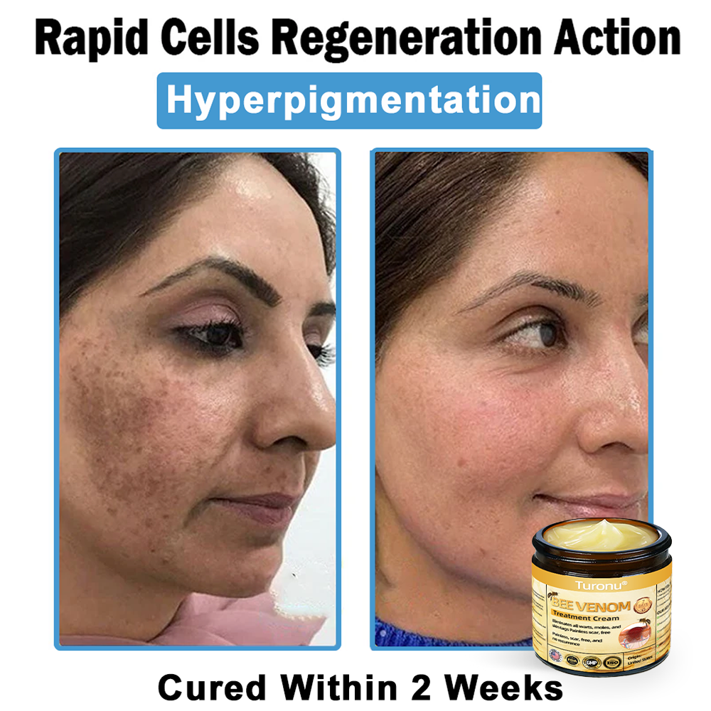 Official Store: Turonu® Bee Venom Skin Treatment Cream👨‍⚕️American Academy of Dermatology (AAD) Approved)💎