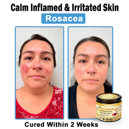 Official Store: Turonu® Bee Venom Skin Treatment Cream👨‍⚕️American Academy of Dermatology (AAD) Approved)💎