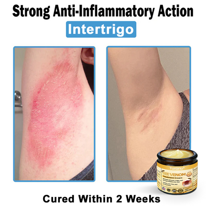 Official Store: Turonu® Bee Venom Skin Treatment Cream👨‍⚕️American Academy of Dermatology (AAD) Approved)💎