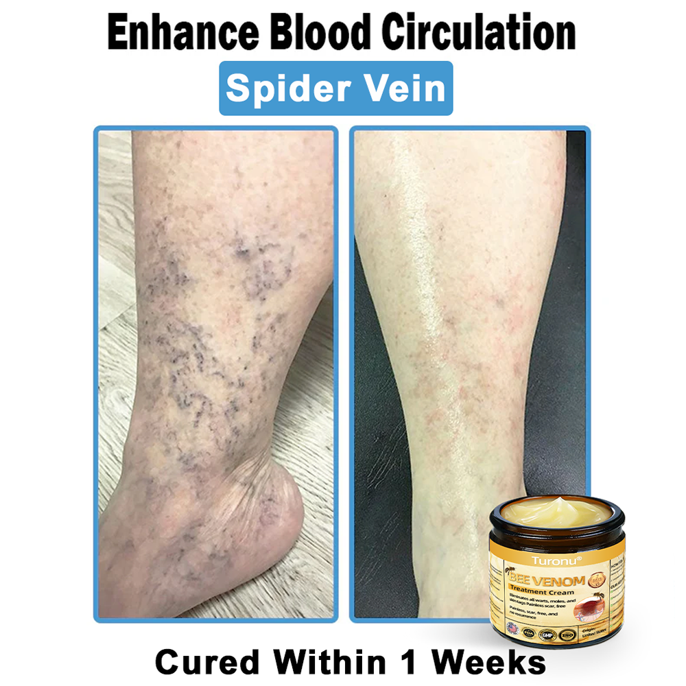Official Store: Turonu® Bee Venom Skin Treatment Cream👨‍⚕️American Academy of Dermatology (AAD) Approved)💎